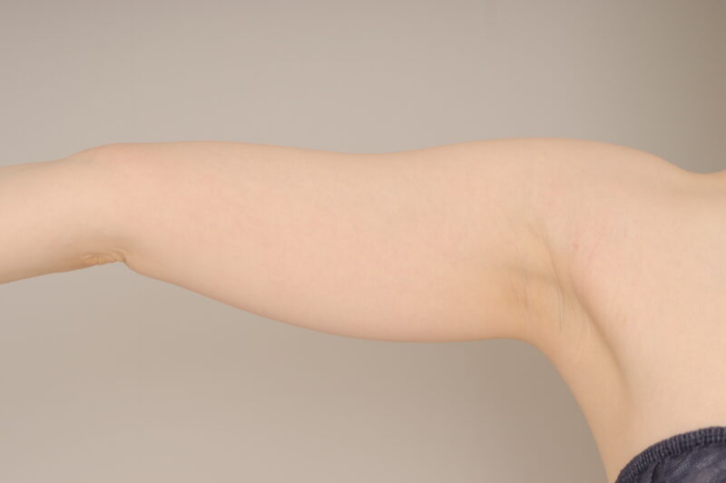 ベイザー脂肪吸引（6か月経過：29）の術前写真