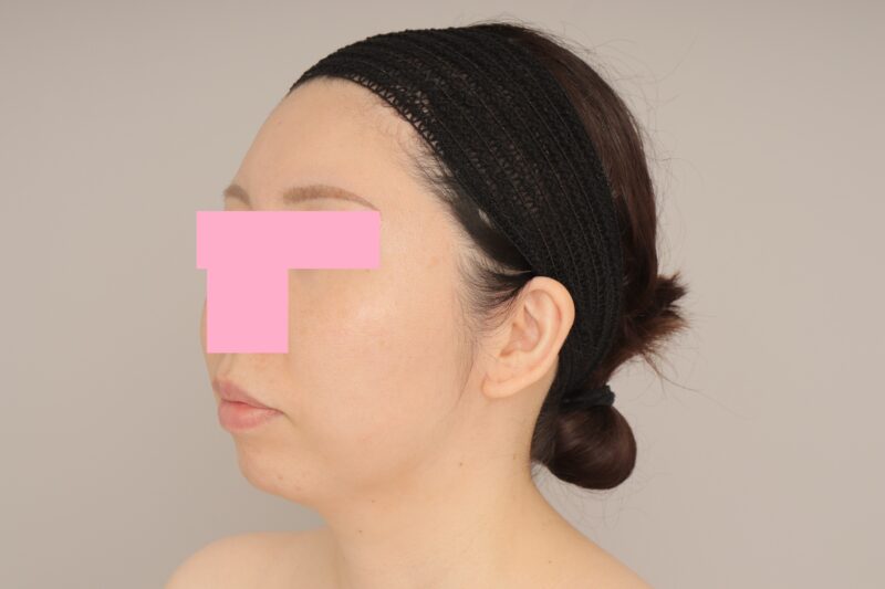 ベイザー脂肪吸引（1ヵ月経過：33）の術前写真