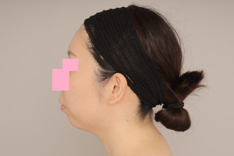 ベイザー脂肪吸引(6か月経過:33)の術前写真