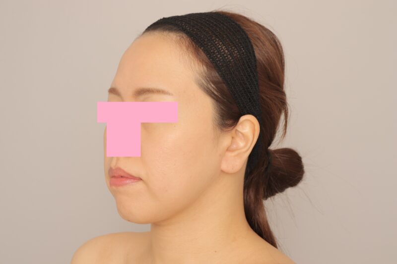 頬顎下脂肪吸引でフェイスラインすっきり！　モニター様の1か月経過をご紹介♪　35歳 168cm 63kg