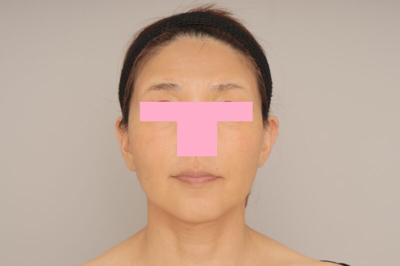 ベイザー脂肪吸引（1ヵ月経過：49）の術前写真