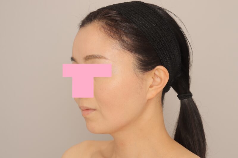 ベイザー脂肪吸引（1ヵ月経過：45）の術後写真