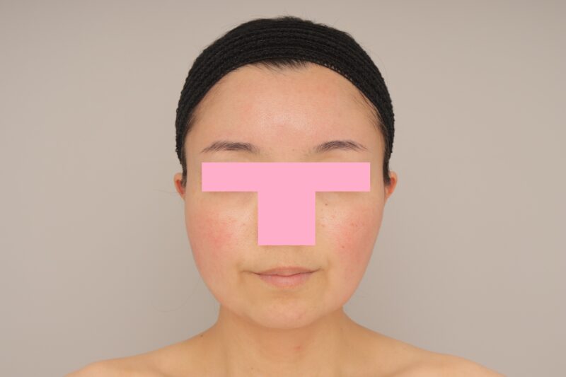 ベイザー脂肪吸引（3か月経過：45）の術前写真