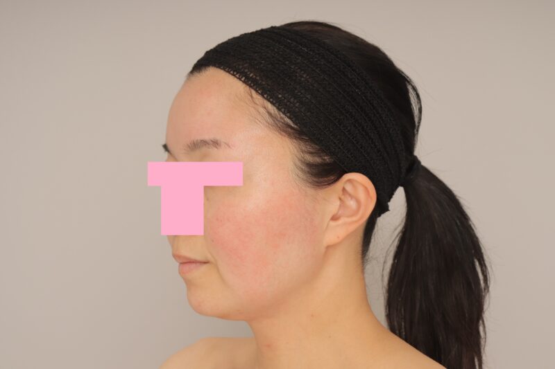 ベイザー脂肪吸引（1ヵ月経過：45）の術前写真