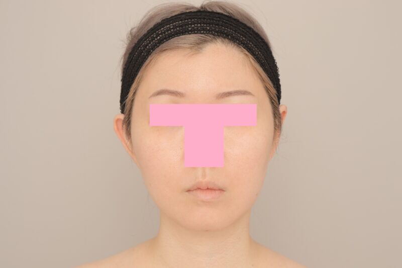 頬顎下脂肪吸引でフェイスラインを整える♪　モニター様の1か月経過をご紹介♪　37歳　165cm 65kg