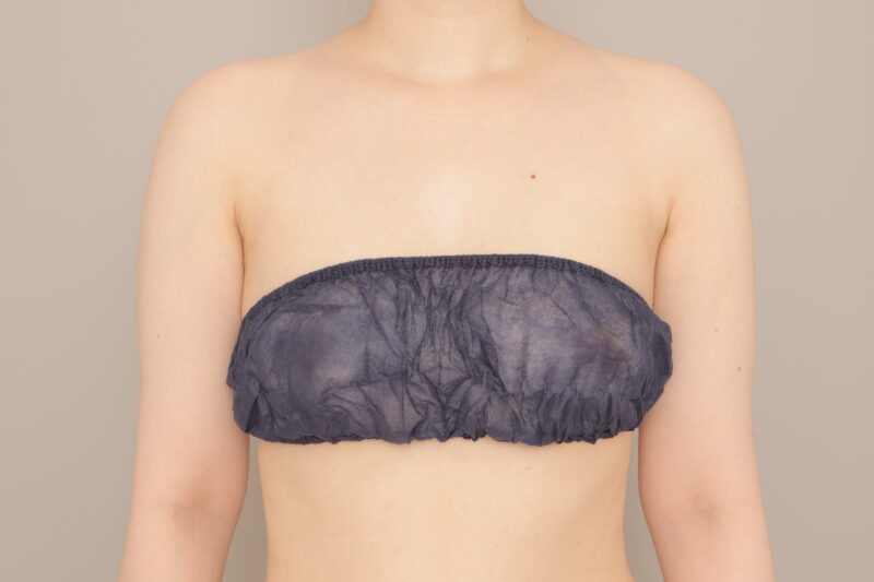 ベイザー脂肪吸引（1ヵ月経過：37）の術後写真