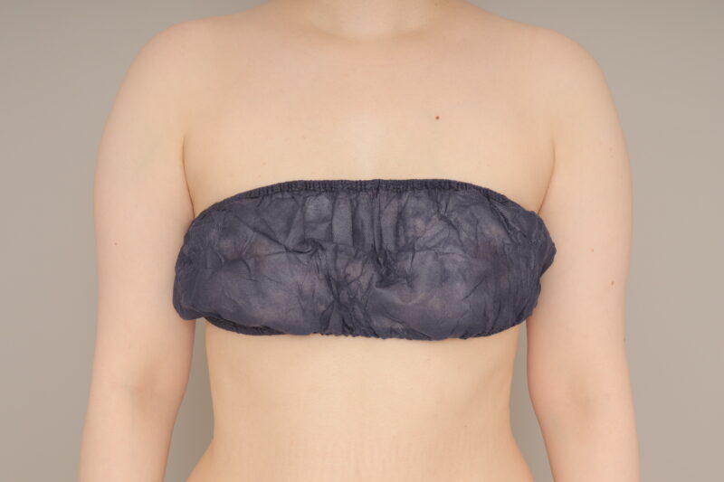 ベイザー脂肪吸引（1ヵ月経過：37）の術前写真