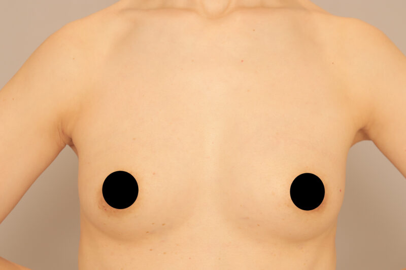 ベイザー脂肪吸引(3か月後経過:39)の術後写真