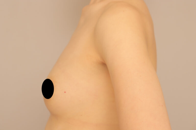 コンデンスリッチ豊胸＆乳頭縮小