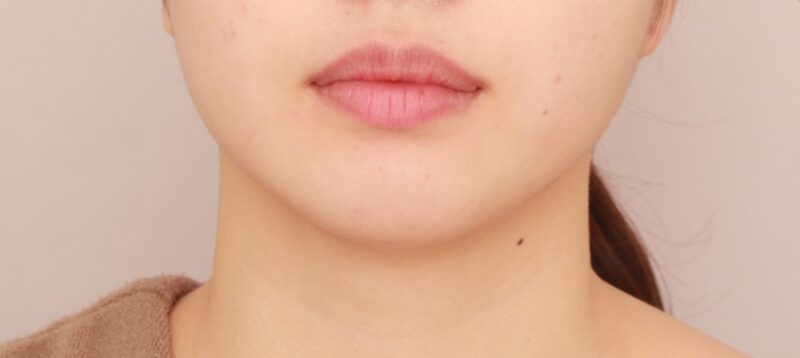 【頬+顎下】フェイスラインをより明瞭に！