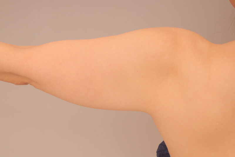 ベイザー脂肪吸引(3ヶ月経過:50)の術前写真