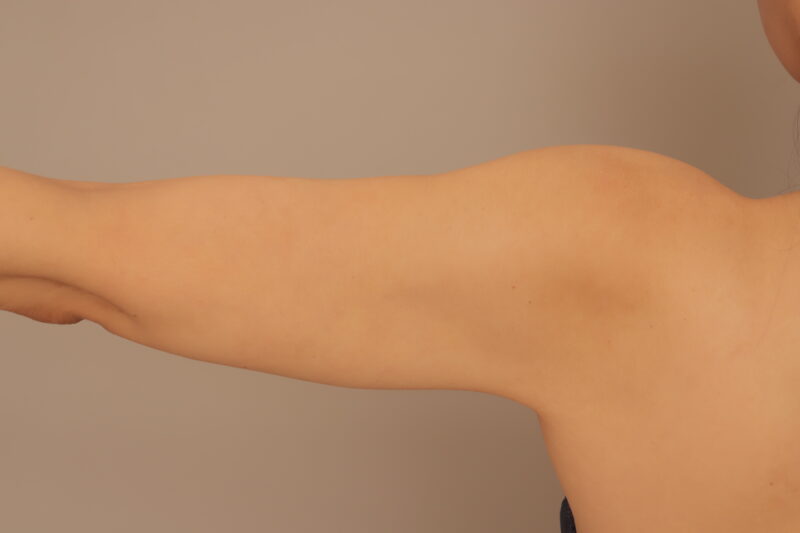 ベイザー脂肪吸引(3ヶ月経過:50)の術後写真