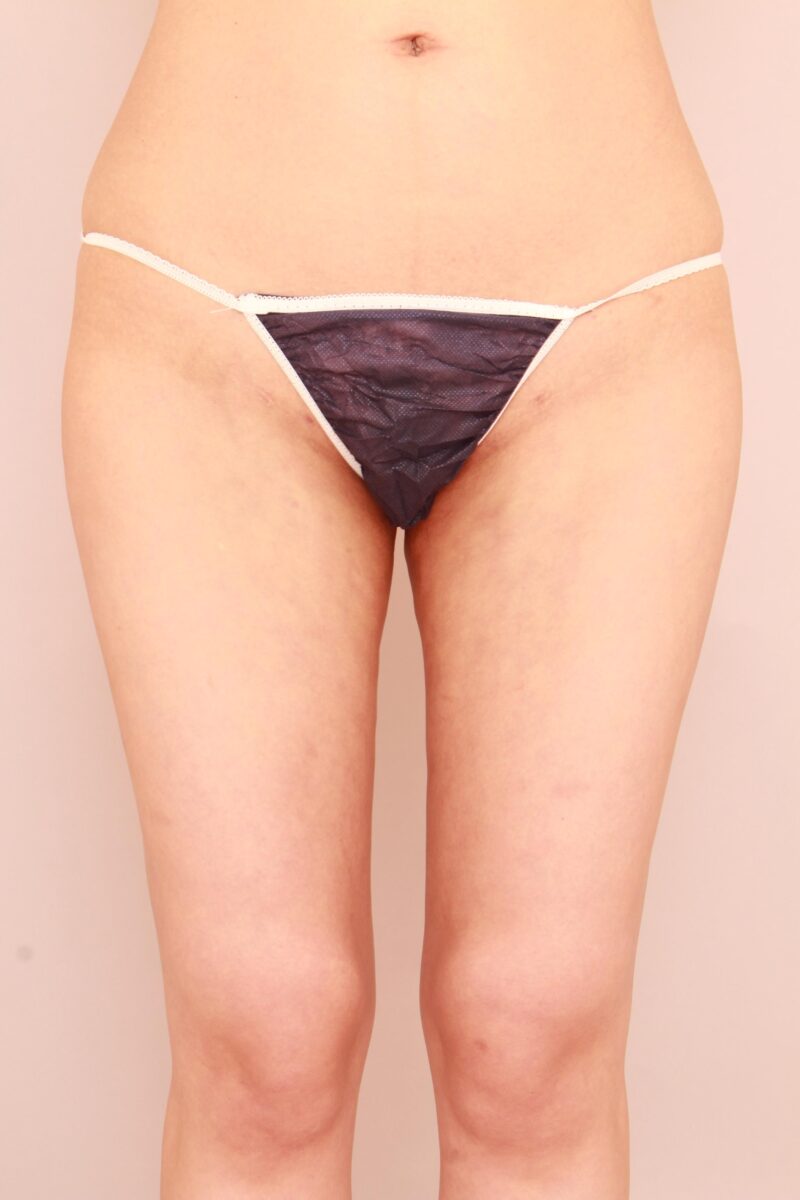 【O脚】内ももの隙間を脂肪吸引で形成