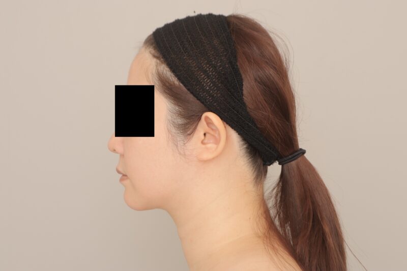 ベイザー脂肪吸引(3ヵ月経過:39)の術後写真