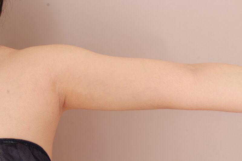 【骨格ストレート】二の腕の外張りやふりそでを効果的に吸引！