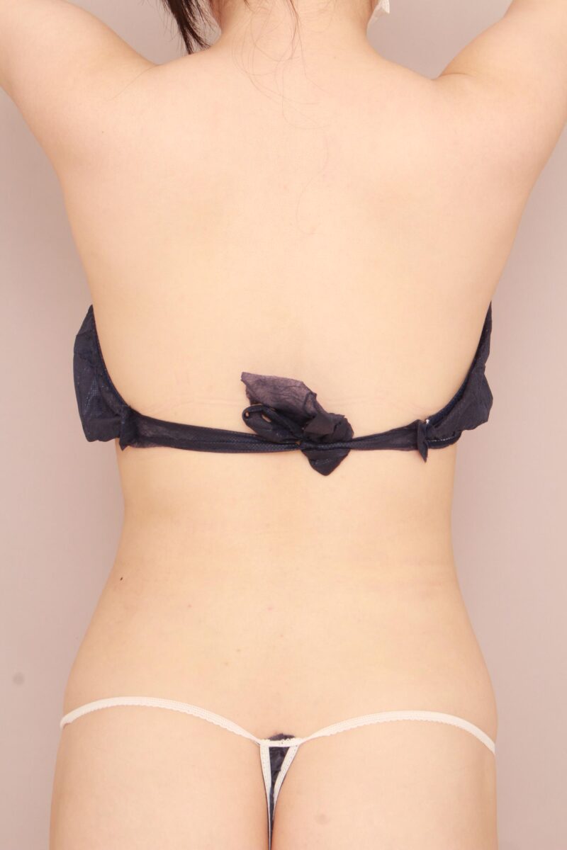 腰の吸引で理想のくびれに！