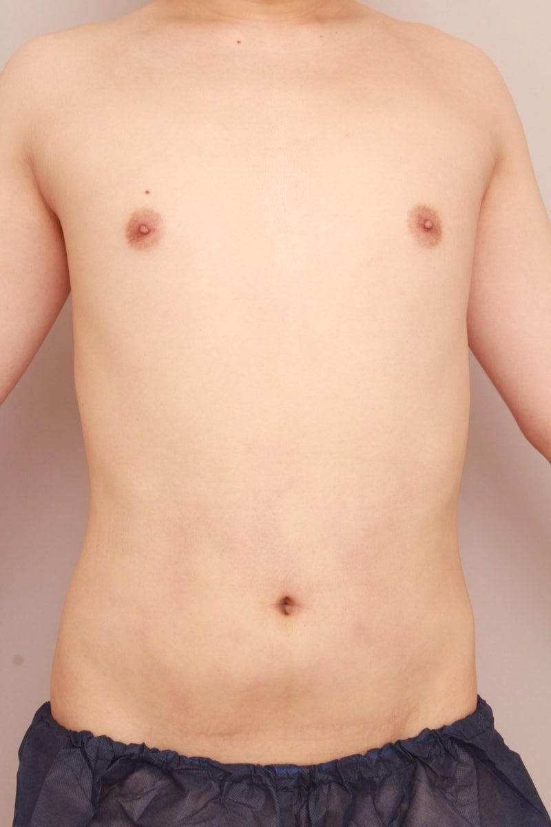 男性のぽっこりお腹も脂肪吸引でスッキリと！