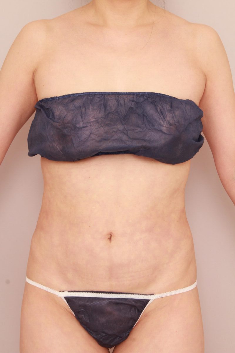 へそ周りや腰回りは脂肪吸引で理想のシルエットづくりを！