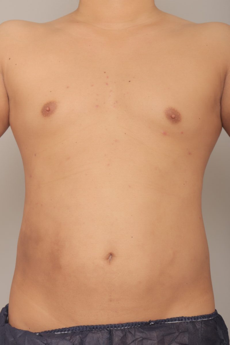 ベイザー脂肪吸引（3か月経過：30）の術後写真