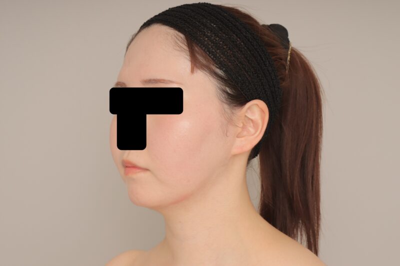 20代女性、お顔の脂肪吸引の3か月経過のご紹介です。