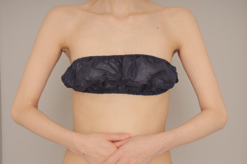 ベイザー脂肪吸引(3か月経過:31)の術後写真