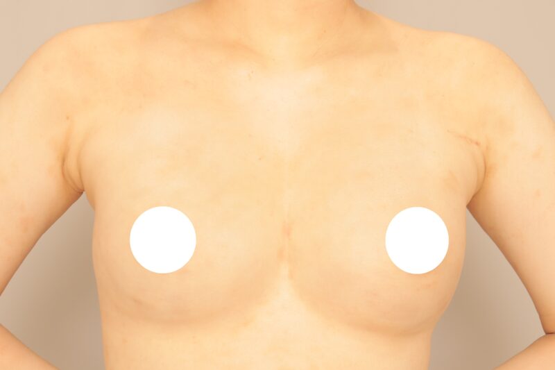 ベイザー脂肪吸引(3ヶ月経過:25)の術後写真