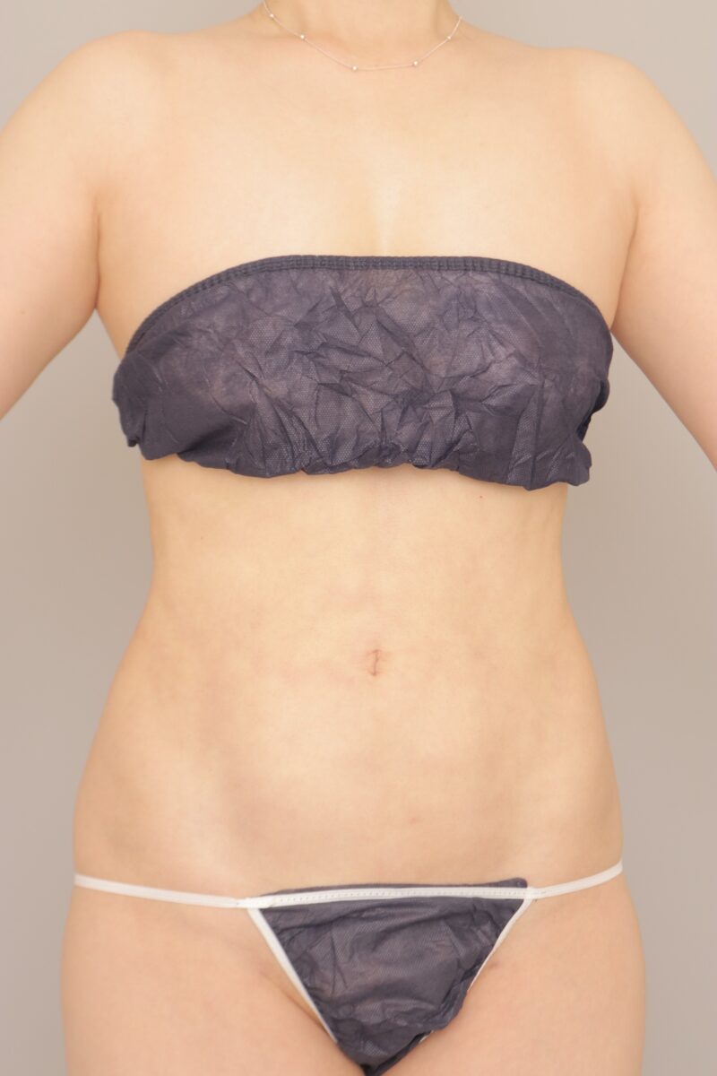 お腹・腰の脂肪吸引　術後3か月の経過