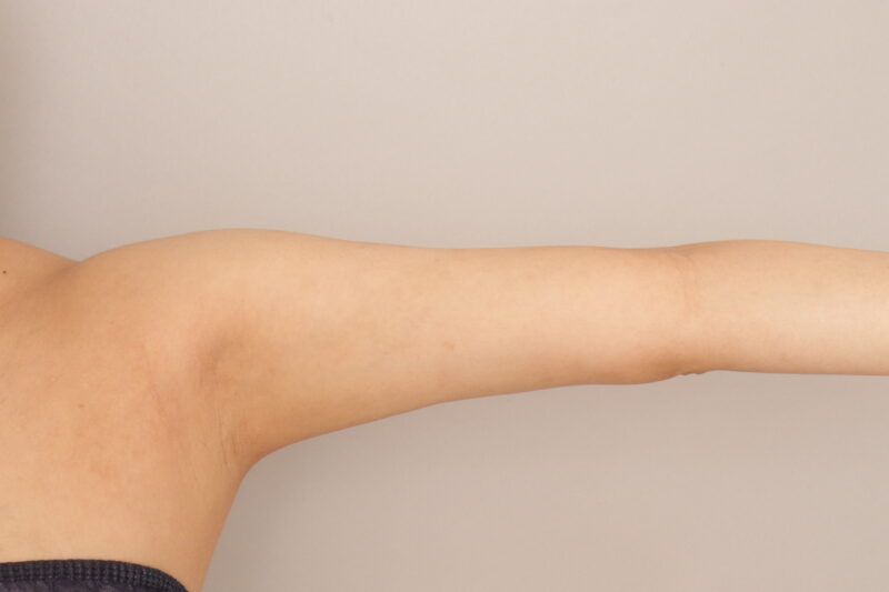 二の腕の脂肪吸引、三か月経過のご紹介です。
