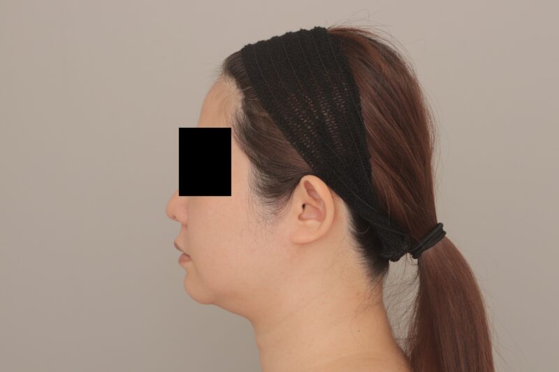 ベイザー脂肪吸引(3ヵ月経過:39)の術前写真