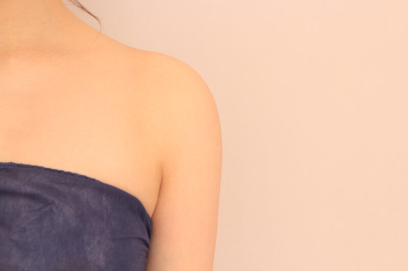 【筋肉質なタイプの二の腕】脂肪吸引で脂肪量を整えて理想のシルエットに近づけることができます