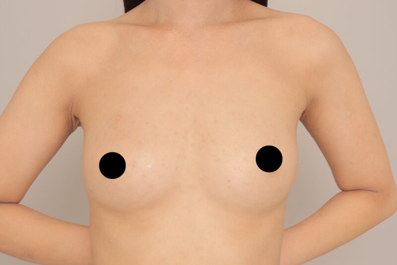 CRF豊胸の１か月経過のご紹介です。