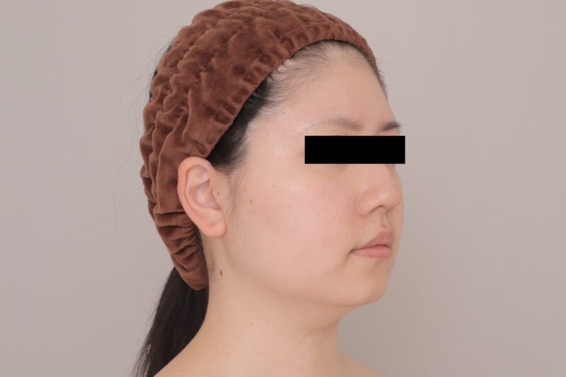 ベイザー脂肪吸引（6ヶ月経過：29）の術前写真