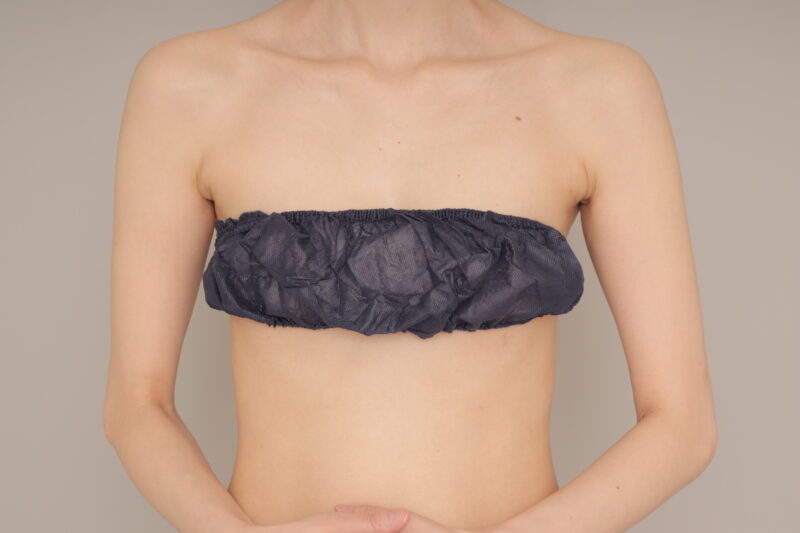 ベイザー脂肪吸引(3か月経過:31)の術前写真