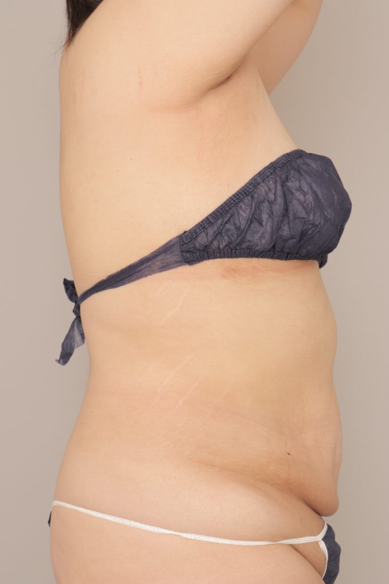 腹部で5000cc以上を吸引した20代女性の方の2ヶ月経過です