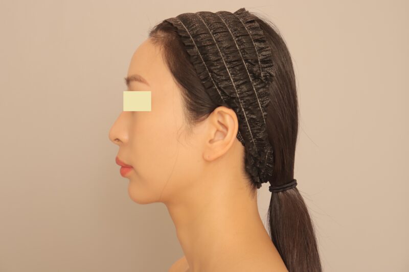 ★実の姉の顎下脂肪吸引術後１ヶ月