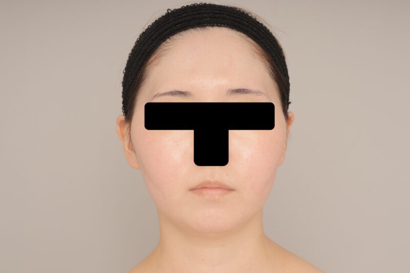 ベイザー脂肪吸引（１ヶ月経過：27）の術前写真