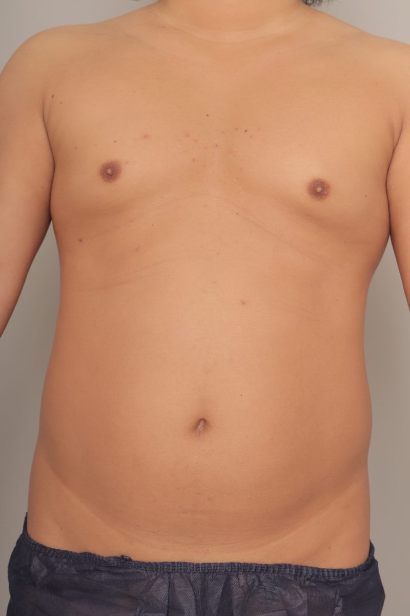 ベイザー脂肪吸引（3か月経過：30）の術前写真