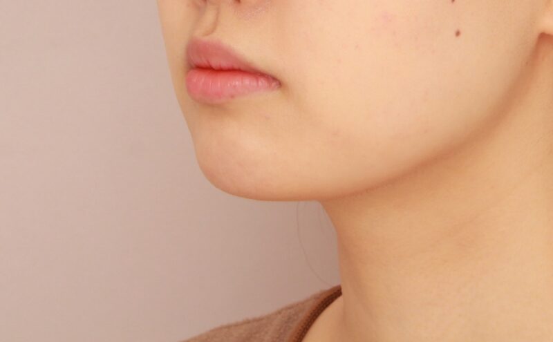 【頬＋顎下】口横のもたつきをスッキリ！