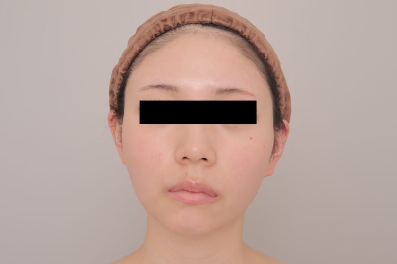 ベイザー脂肪吸引（3ヶ月経過：20）の術前写真