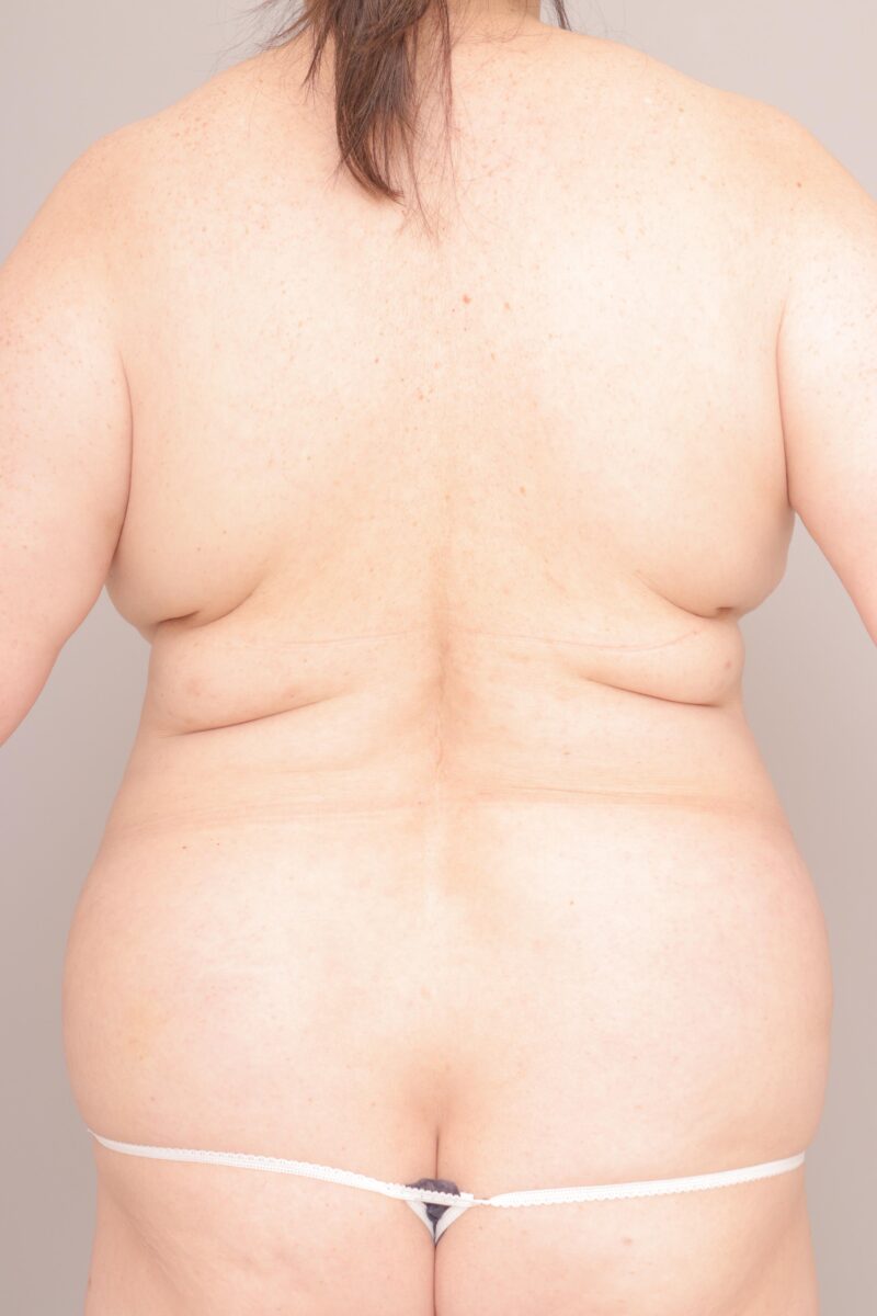 ベイザー脂肪吸引(術後1ヶ月経過:59)の術前写真