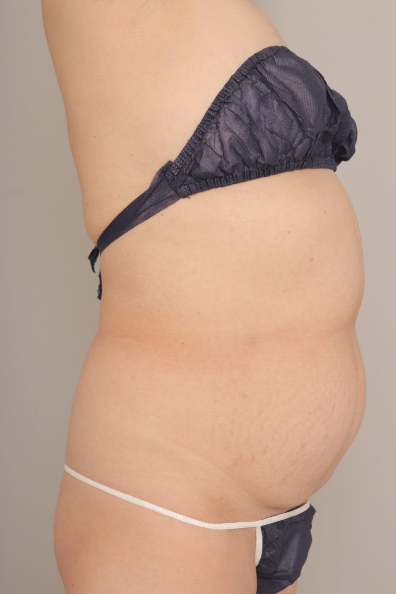 ベイザー脂肪吸引（3か月経過：57）の術前写真