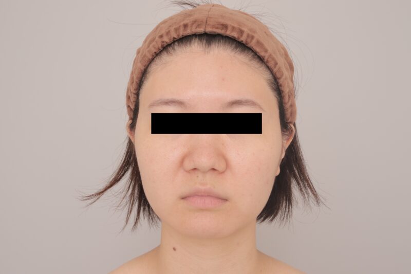 ベイザー脂肪吸引（3ヶ月経過：30）の術前写真