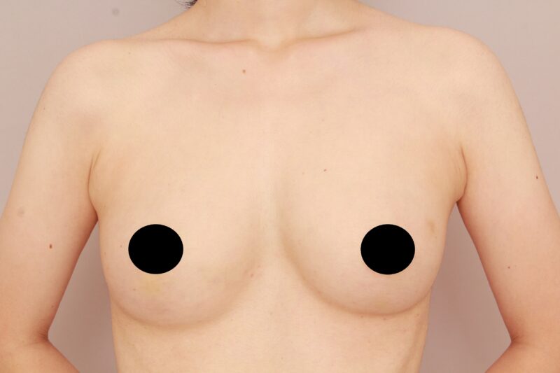 【脂肪豊胸】インプラント豊胸のみでは難しい、自然なバストに！