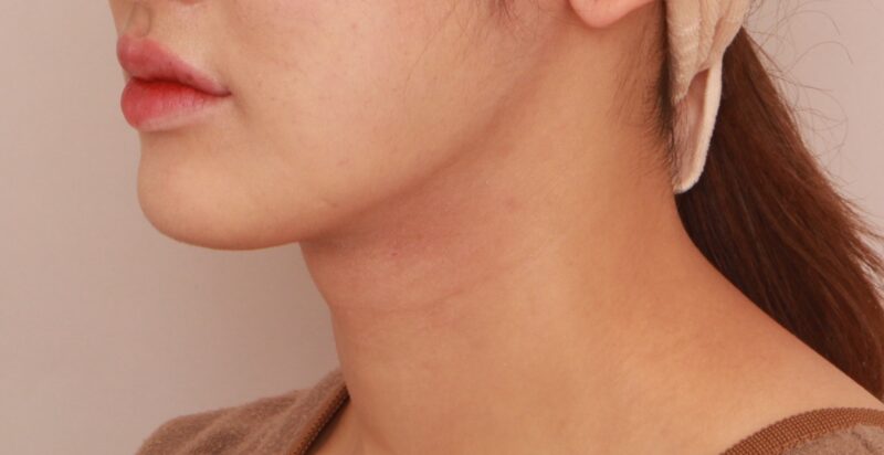 【頬＋顎下】よりフェイスラインをはっきり出すことができます！