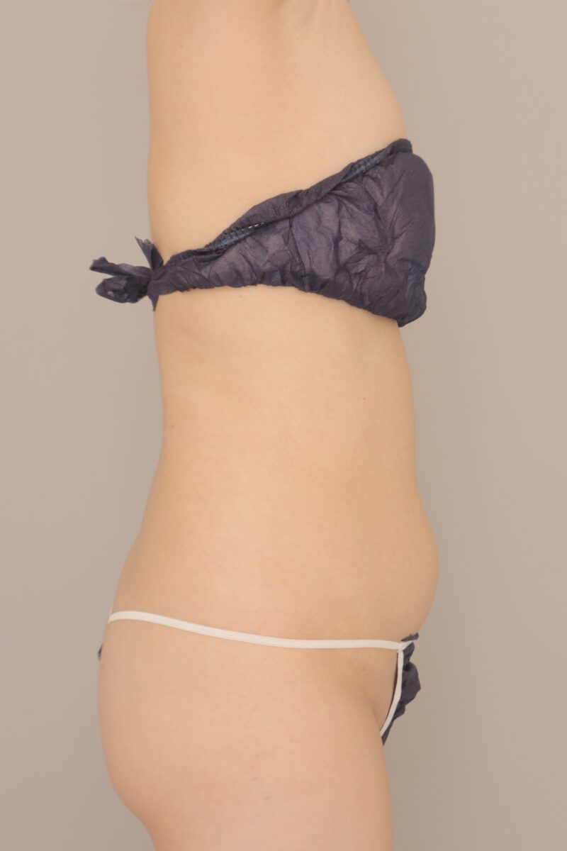 ベイザー脂肪吸引（3か月経過：43）の術前写真