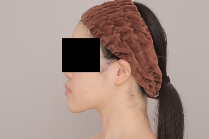 ベイザー脂肪吸引(3ヶ月経過:22)の術後写真