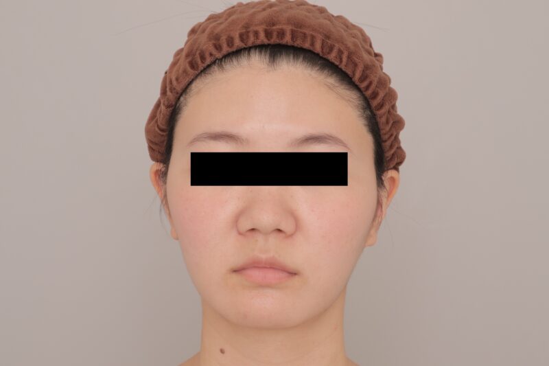 ベイザー脂肪吸引（3ヶ月経過：30）の術後写真