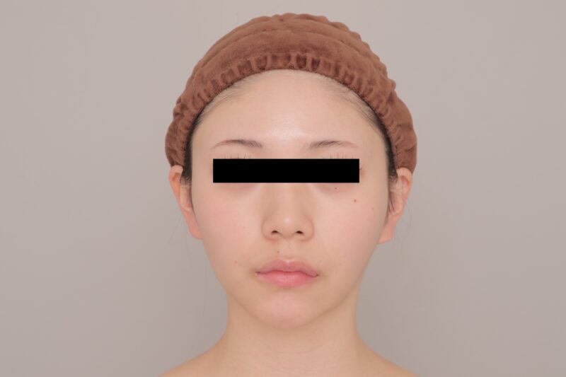 ベイザー脂肪吸引（3ヶ月経過：20）の術後写真