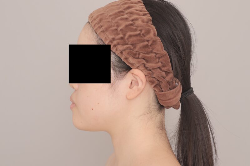 ベイザー脂肪吸引(3ヶ月経過:22)の術前写真