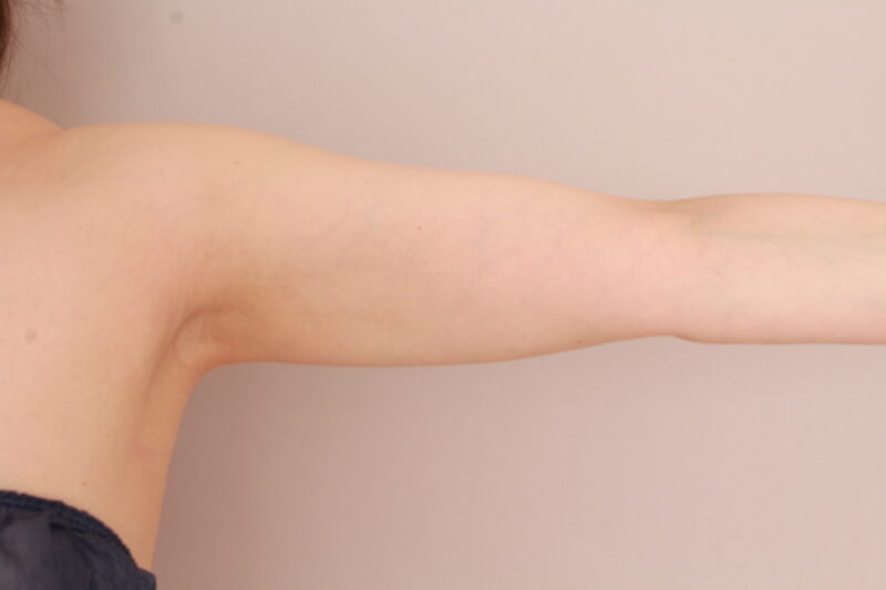 【骨格ウェーブ】二の腕がふりそでになる方も吸引でスッキリシルエットに！